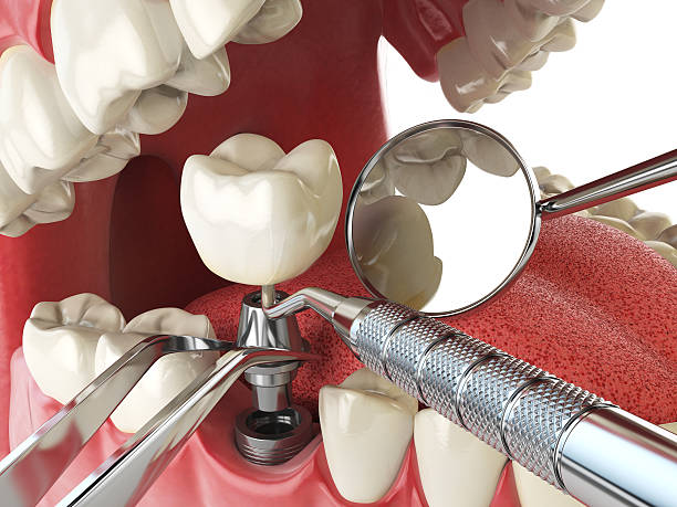 Best Emergency Wisdom Teeth Removal in Falfurrias, TX